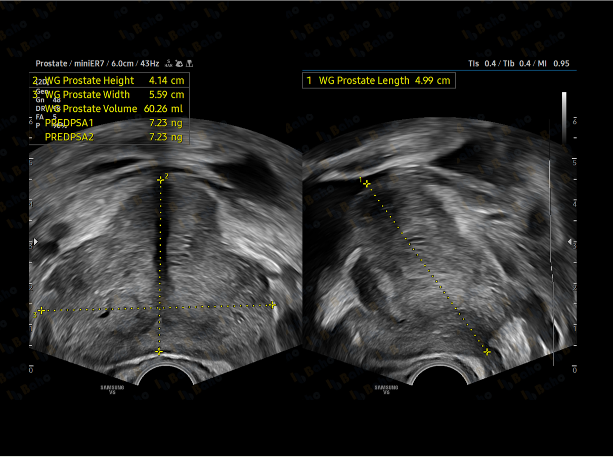 miniER7 - Transrectal Ultrasound Transducer 3
